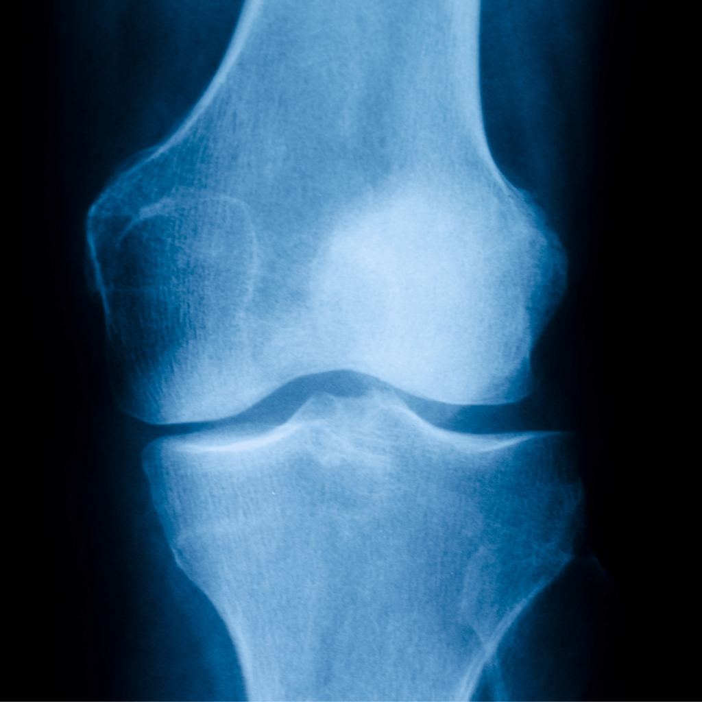 xray of knee with osteoarthritis